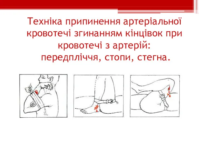 Техніка припинення артеріальної кровотечі згинанням кінцівок при кровотечі з артерій: передпліччя, стопи, стегна.