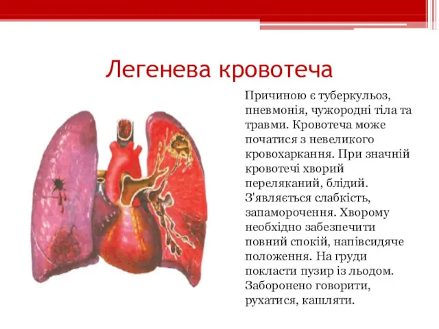 Легенева кровотеча Причиною є туберкульоз, пневмонія, чужородні тіла та травми. Кровотеча може початися