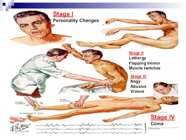 Stage I Personality Changes Stage II Lethergy Flapping tremor Muscle
