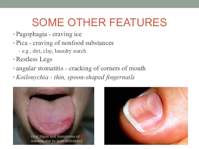 SOME OTHER FEATURES Pagophagia - craving ice Pica - craving