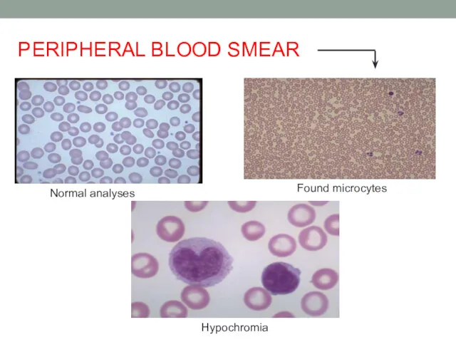 Hypochromia Normal analyses Found microcytes PERIPHERAL BLOOD SMEAR