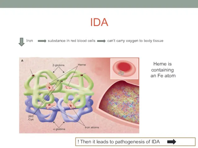 IDA Iron substance in red blood cells can’t carry oxygen