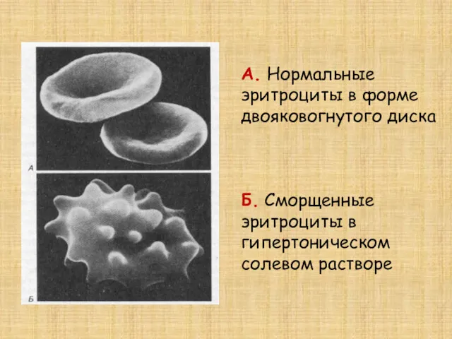 А. Нормальные эритроциты в форме двояковогнутого диска Б. Сморщенные эритроциты в гипертоническом солевом растворе