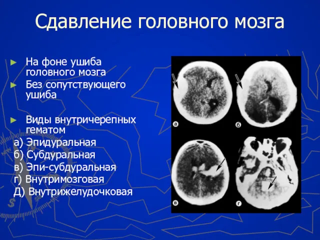 Сдавление головного мозга На фоне ушиба головного мозга Без сопутствующего