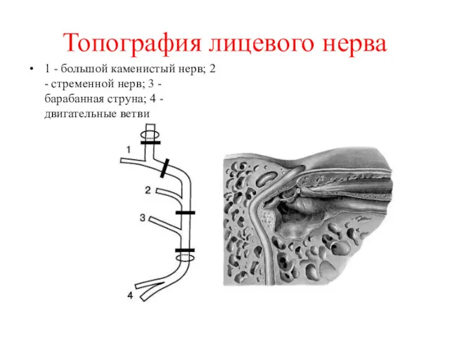 Топография лицевого нерва 1 - большой каменистый нерв; 2 -