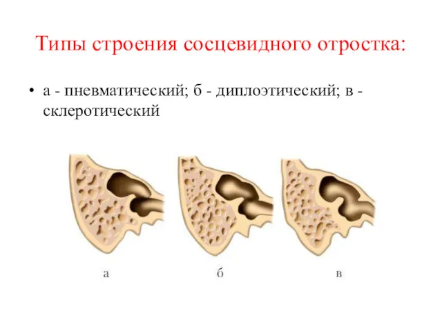 Типы строения сосцевидного отростка: а - пневматический; б - диплоэтический; в - склеротический