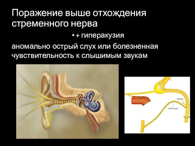 Поражение выше отхождения стременного нерва + гиперакузия аномально острый слух или болезненная чувствительность к слышимым звукам