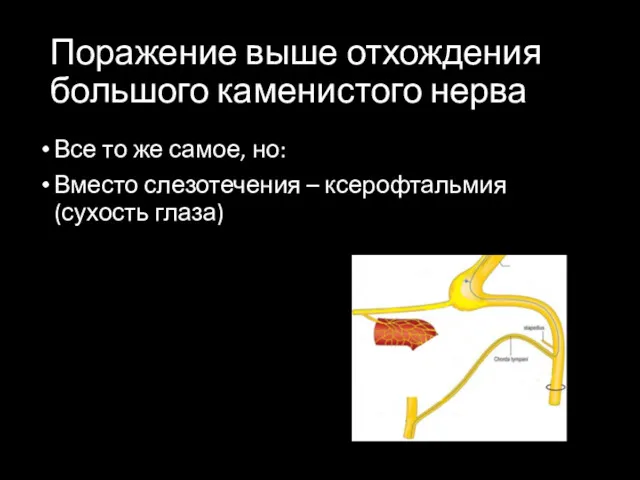 Поражение выше отхождения большого каменистого нерва Все то же самое,