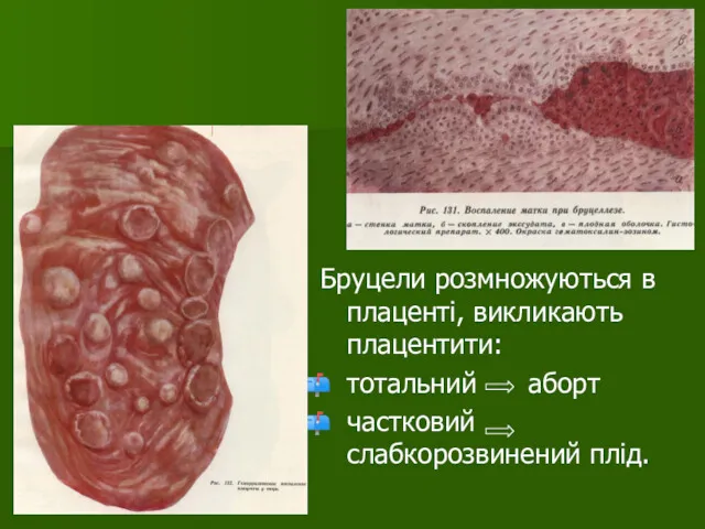 Бруцели розмножуються в плаценті, викликають плацентити: тотальний аборт частковий слабкорозвинений плід.
