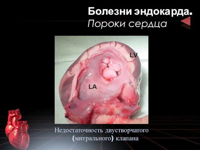 Болезни эндокарда. Пороки сердца Недостаточность двустворчатого (митрального) клапана