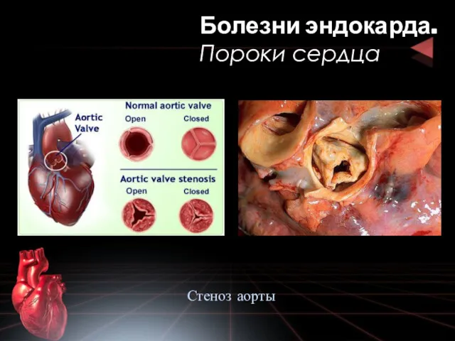 Болезни эндокарда. Пороки сердца Стеноз аорты