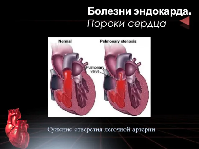 Болезни эндокарда. Пороки сердца Сужение отверстия легочной артерии