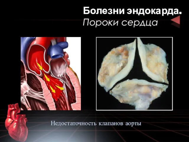 Болезни эндокарда. Пороки сердца Недостаточность клапанов аорты
