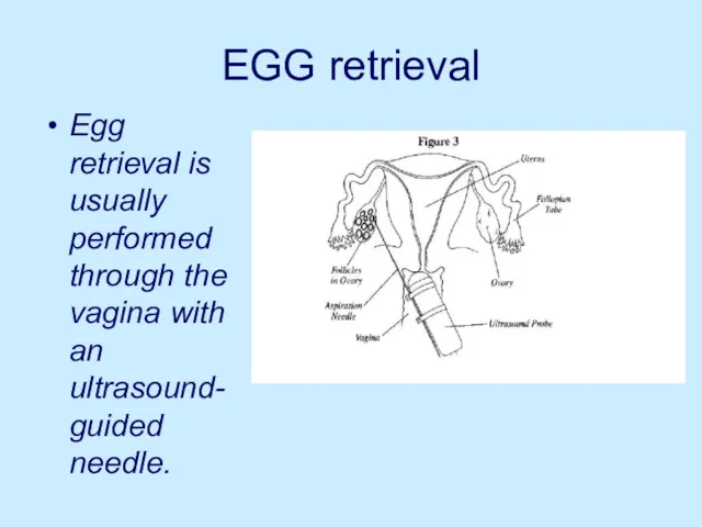 EGG retrieval Egg retrieval is usually performed through the vagina with an ultrasound-guided needle.