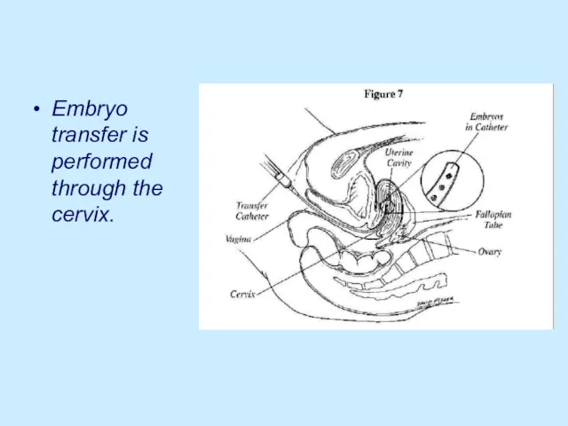 Embryo transfer is performed through the cervix.