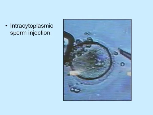 Intracytoplasmic sperm injection