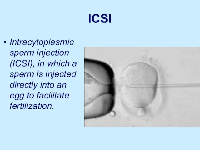 ICSI Intracytoplasmic sperm injection (ICSI), in which a sperm is