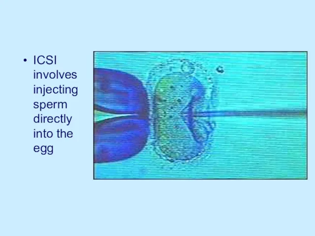 ICSI involves injecting sperm directly into the egg