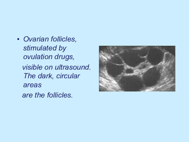 Ovarian follicles, stimulated by ovulation drugs, visible on ultrasound. The dark, circular areas are the follicles.