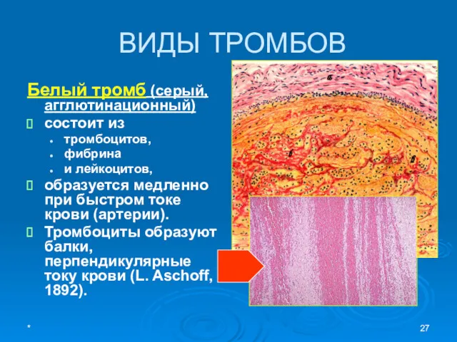 ВИДЫ ТРОМБОВ Белый тромб (серый, агглютинационный) состоит из тромбоцитов, фибрина