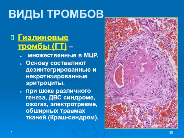 ВИДЫ ТРОМБОВ Гиалиновые тромбы (ГТ) – множественные в МЦР. Основу составляют дезинтегрированные и