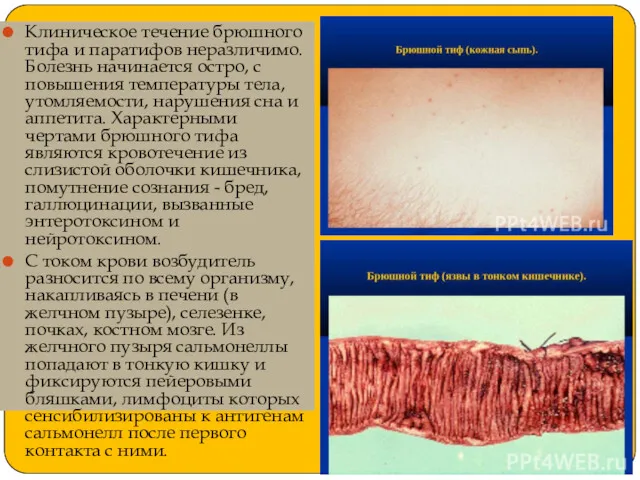 Клиническое течение брюшного тифа и паратифов неразличимо. Болезнь начинается остро,