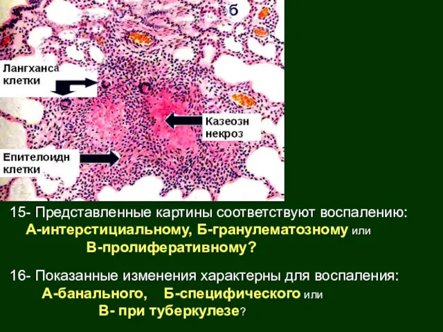 15- Представленные картины соответствуют воспалению: А-интерстициальному, Б-гранулематозному или В-пролиферативному? 16-