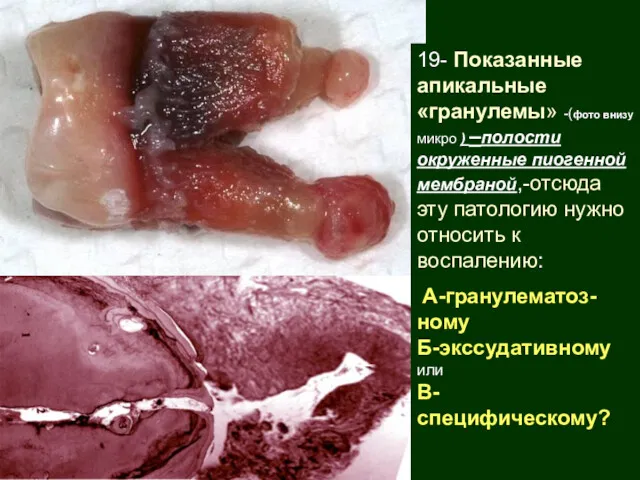 19- Показанные апикальные «гранулемы» -(фото внизу микро ) –полости окруженные