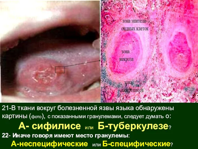 21-В ткани вокруг болезненной язвы языка обнаружены картины (фото), с