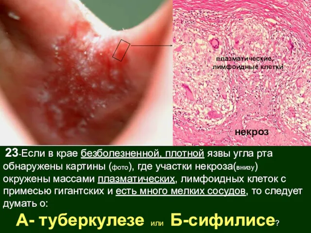 23-Если в крае безболезненной, плотной язвы угла рта обнаружены картины