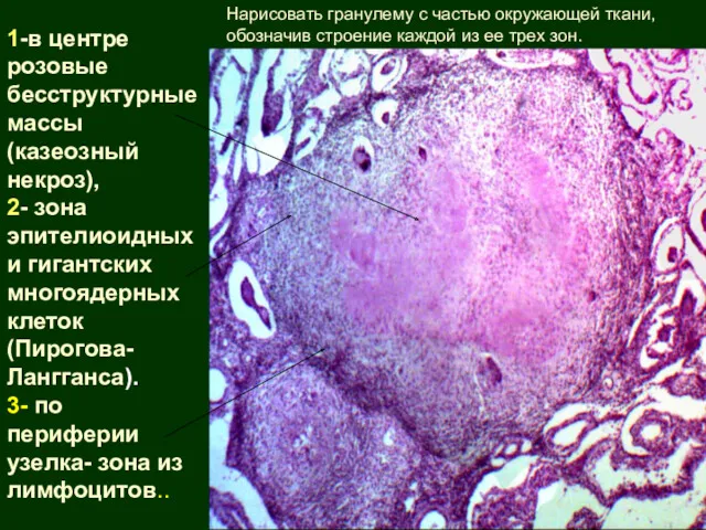 1-в центре розовые бесструктурные массы (казеозный некроз), 2- зона эпителиоидных