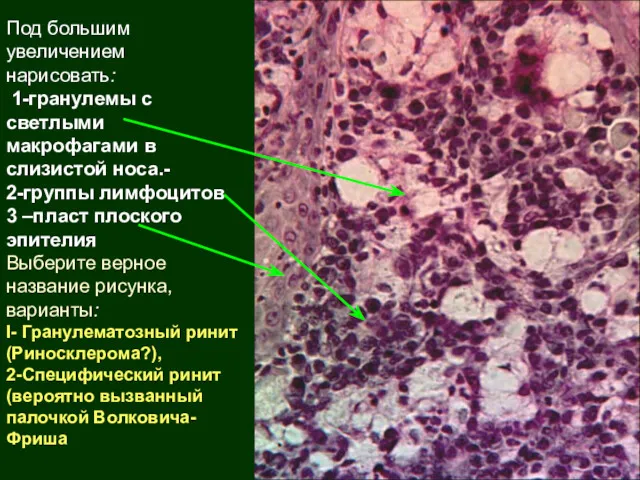 Под большим увеличением нарисовать: 1-гранулемы с светлыми макрофагами в слизистой