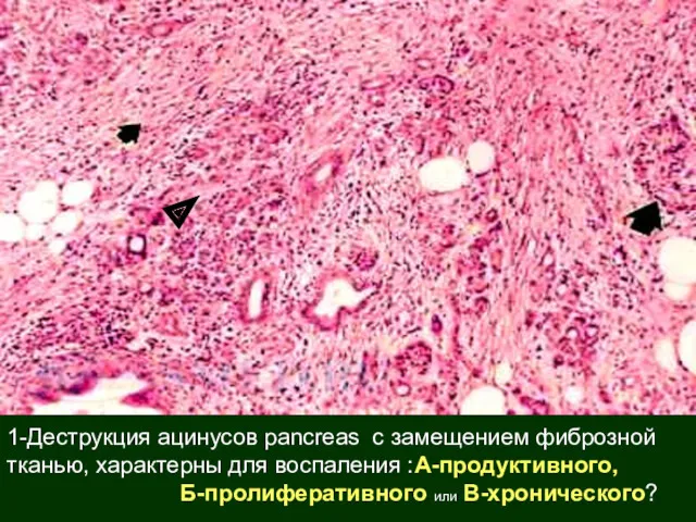 1-Деструкция ацинусов pancreas с замещением фиброзной тканью, характерны для воспаления :А-продуктивного, Б-пролиферативного или В-хронического?
