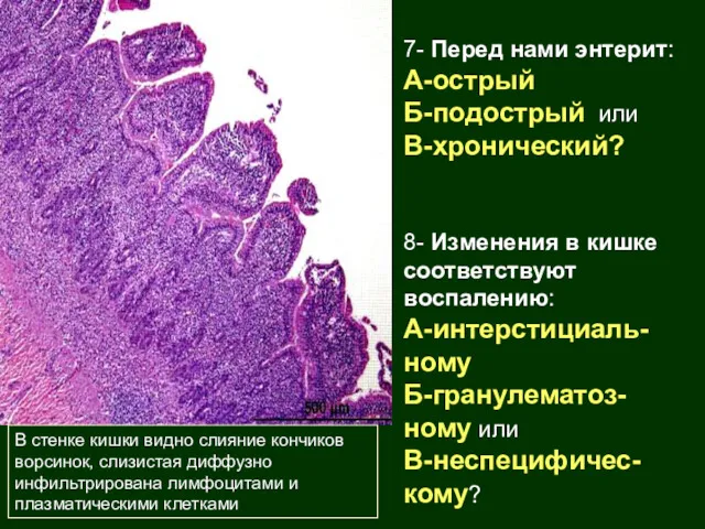 В стенке кишки видно слияние кончиков ворсинок, слизистая диффузно инфильтрирована