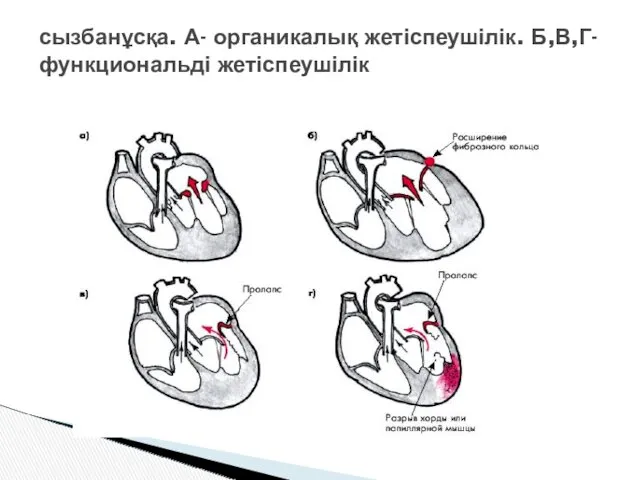 сызбанұсқа. А- органикалық жетіспеушілік. Б,В,Г- функциональді жетіспеушілік