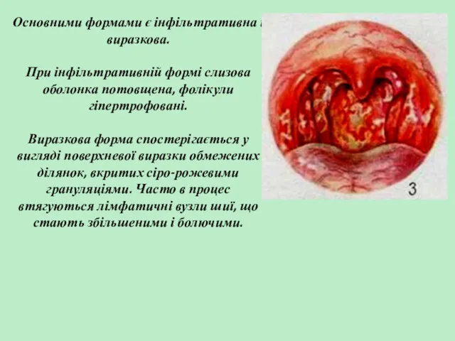 Основними формами є інфільтративна і виразкова. При інфільтративній формі слизова