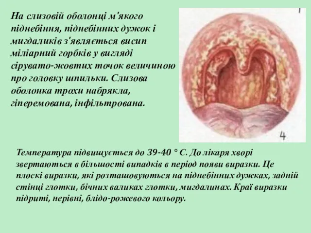 На слизовій оболонці м'якого піднебіння, піднебінних дужок і мигдаликів з'являється