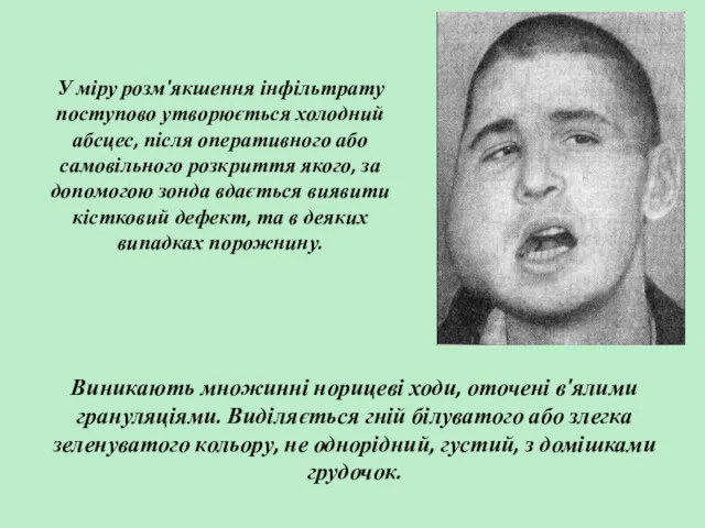 У міру розм'якшення інфільтрату поступово утворюється холодний абсцес, після оперативного