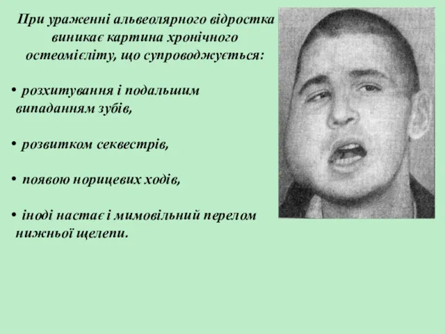 При ураженні альвеолярного відростка виникає картина хронічного остеомієліту, що супроводжується: розхитування і подальшим