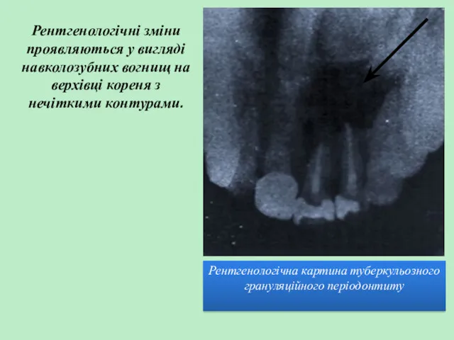 Рентгенологічна картина туберкульозного грануляційного періодонтиту Рентгенологічні зміни проявляються у вигляді