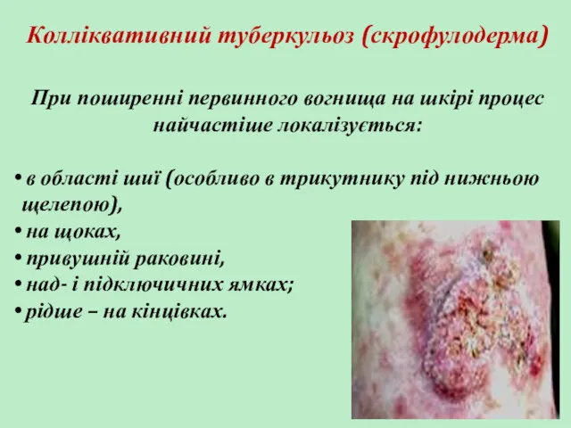 Колліквативний туберкульоз (скрофулодерма) При поширенні первинного вогнища на шкірі процес найчастіше локалізується: в