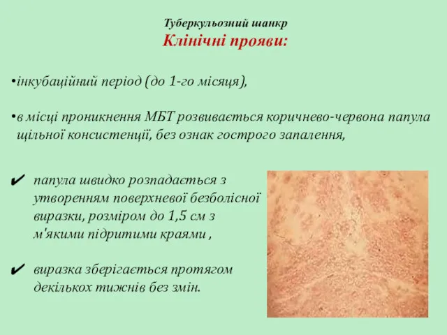 Туберкульозний шанкр Клінічні прояви: інкубаційний період (до 1-го місяця), в