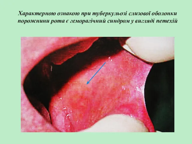 Характерною ознакою при туберкульозі слизової оболонки порожнини рота є геморагічний синдром у вигляді петехій