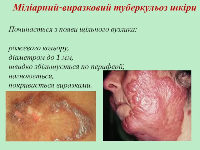 Міліарний-виразковий туберкульоз шкіри Починається з появи щільного вузлика: рожевого кольору, діаметром до 1
