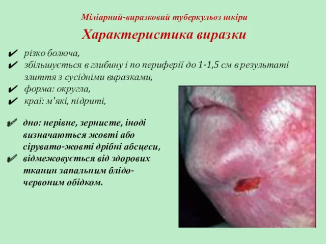 Міліарний-виразковий туберкульоз шкіри різко болюча, збільшується в глибину і по периферії до 1-1,5