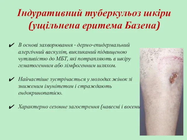 Індуративний туберкульоз шкіри (ущільнена еритема Базена) В основі захворювання -