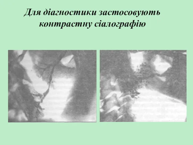 Для діагностики застосовують контрастну сіалографію