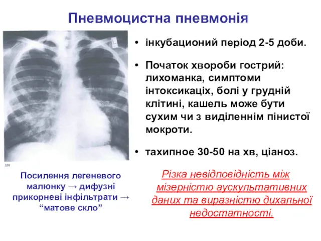 Пневмоцистна пневмонія інкубационий період 2-5 доби. Початок хвороби гострий: лихоманка,