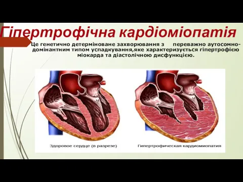 Гіпертрофічна кардіоміопатія Це генетично детерміноване захворювання з переважно аутосомно-домінантним типом