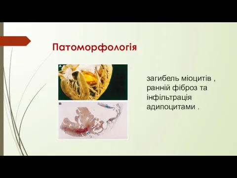 Патоморфологія загибель міоцитів , ранній фіброз та інфільтрація адипоцитами .
